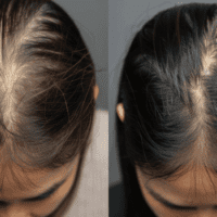 Image 01 - Reverses hair loss